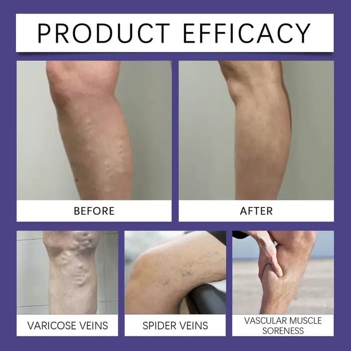 Stylo sans fil pour l'élimination des varices à domicile – Outil de soin des veines pour soulagement quotidien, post-partum et usage nocturne en salon