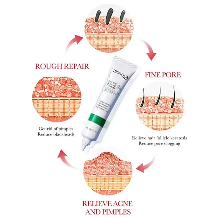 Crème Traitante Anti-Acné à l'Acide Salicylique : Régule la Sécrétion de Sébum, Minimise les Pores, Apaise les Rougeurs Irritées, Élimine les Boutons, Répare la Peau