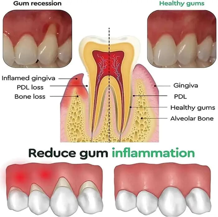 Gel de réparation rapide des gencives, soulage efficacement l'allergie dentaire, carie dentaire, nettoyage des dents, dentifrice, soulage les dommages dentaires, sérum